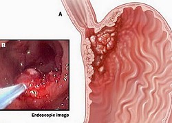 Dấu hiệu ung thư dạ dày giai đoạn sớm