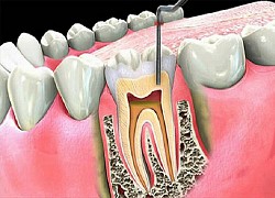 Đề phòng biến chứng viêm xương tủy hàm