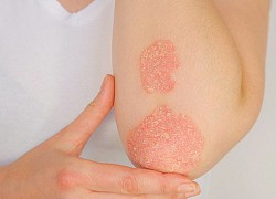 Lupus ban đỏ và vảy nến khác nhau như thế nào?