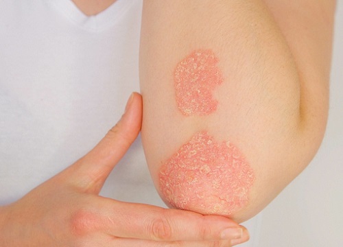 Lupus ban đỏ và vảy nến khác nhau như thế nào?