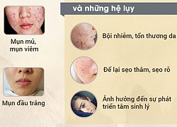 Cách hay để mụn trứng cá &#8220;lặn tăm&#8221;