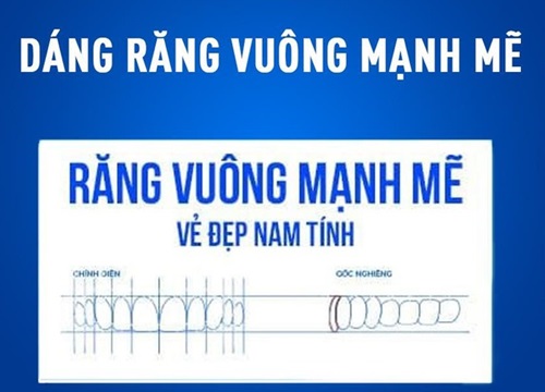 4 dáng răng sứ được yêu thích hiện nay