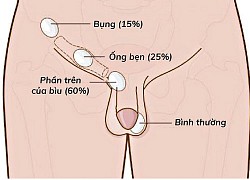 Ẩn tinh hoàn trẻ em Hành trình đi tìm "hòn ngọc" cho bé phát triển bình thường