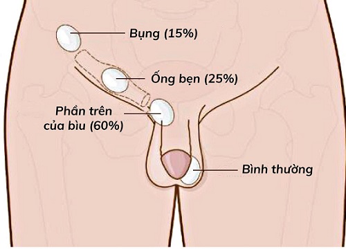 Ẩn tinh hoàn trẻ em Hành trình đi tìm "hòn ngọc" cho bé phát triển bình thường