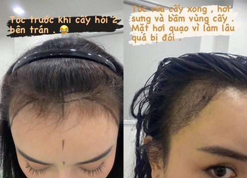 'Phạm Băng Băng phiên bản Việt' chi cả trăm triệu đồng chữa hói