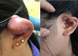 Tai mưng mủ, phù nề nặng sau khi xỏ khuyên