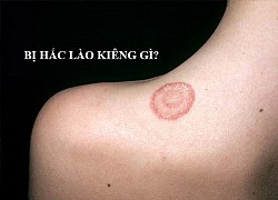 Chữa hắc lào có cần kiêng tắm?