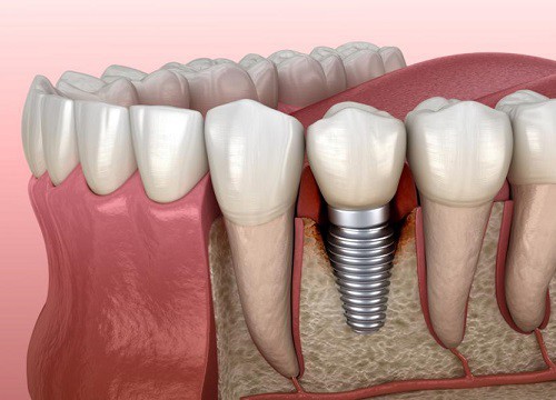 Viêm quanh Implant: Cách phòng ngừa và điều trị