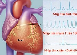 Rủi ro tiềm ẩn khi dùng thuốc chống rối loạn nhịp tim