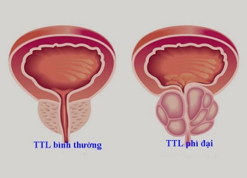 Biện pháp điều trị phì đại tiền liệt tuyến hiệu quả