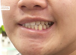 Gia tăng bệnh nhân liệt mặt, méo miệng do lạnh