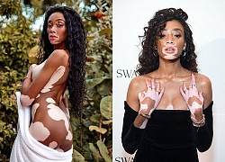 Winnie Harlow đẹp bấn loạn trong bộ ảnh giáng sinh