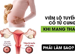 Viêm lộ tuyến cổ tử cung khi mang thai: Nguyên nhân và cách điều trị kịp thời