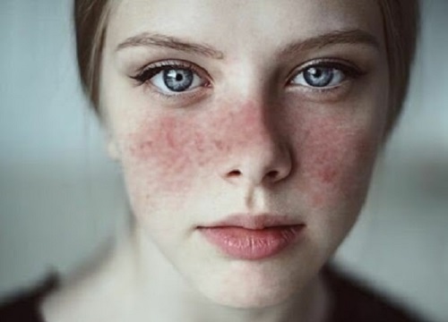 Bệnh lupus ban đỏ nguy hiểm thế nào?