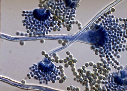 Nấm phổi do Aspergillus: Nhiều quốc gia không đủ nguồn lực để chẩn đoán và điều trị