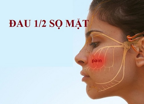 Đau nửa sọ mặt và hội chứng đau nhức sọ mặt