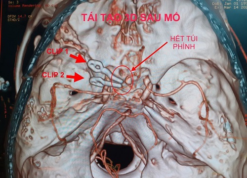 Cấp cứu thành công một trường hợp túi phình động mạch não bị vỡ