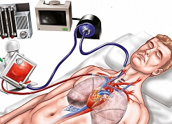 ECMO là gì, khi nào bệnh nhân cần can thiệp ECMO?