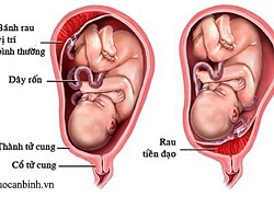 Những điều về rau tiền đạo mà chị em nên biết