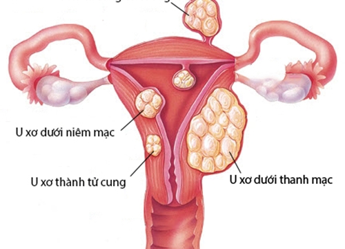 Cường Estrogen - Căn nguyên gây tái phát của U xơ tử cung