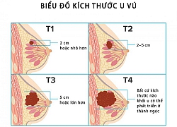 Xác định giai đoạn ung thư vú qua kích thước khối u