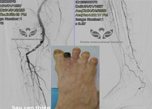 Cụ ông 82 tuổi thoát khỏi đoạn chi nhờ đặt stent nong động mạch