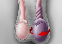 Hoại tử tinh hoàn vì không vào viện khám