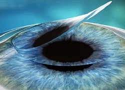 Phẫu thuật lasik - những điều nên biết