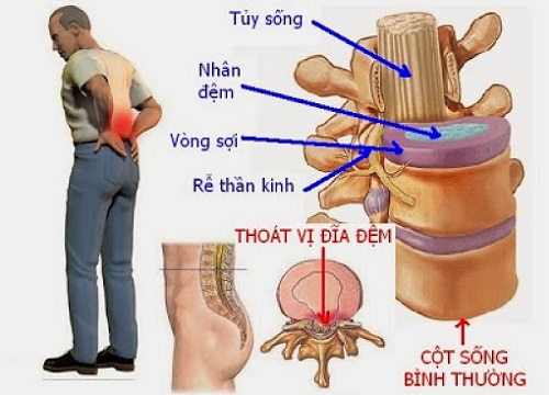 Thoát vị đĩa đệm: Khi nào cần phẫu thuật?