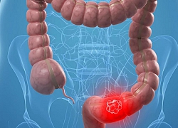 Polyp đại tràng có tiến triển thành ung thư?