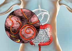 Phát hiện ổ giun kim trong đại tràng