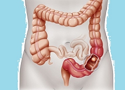 Những người nào dễ mắc ung thư trực tràng?