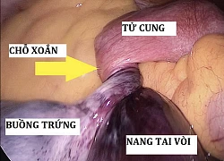 TP.HCM: Đau bụng dữ dội, bé gái 11 tuổi phải mổ khẩn cấp vì căn bệnh nguy hiểm có thể gây vô sinh