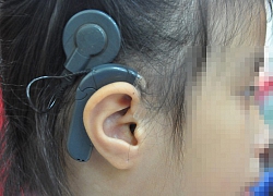 Cậu bé mọc nấm mốc ở ống tai vì đeo tai nghe quá nhiều