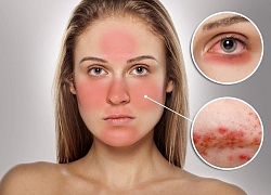 Cứu cánh thải độc da nhiễm corticoid trong thời gian ngắn nhất