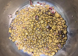 Mổ gắp 1258 viên sỏi thận: Căn bệnh không có triệu chứng cho đến khi bị đe dọa tính mạng