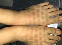 Người phụ nữ bỏng rộp da sau tắm biển