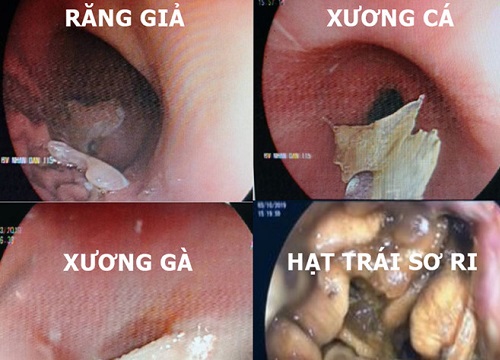 Phải làm gì khi lỡ nuốt dị vật?