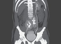 Bị đau lưng mới biết mình có&#8230; 3 thận