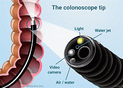 Bác sĩ diệt mầm mống ung thư đại tràng bằng kỹ thuật nội soi như thế nào?