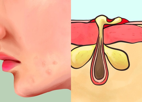 Nguyên nhân gây ra 6 loại mụn trứng cá phổ biến mà ít nhất ai cũng từng gặp phải một lần trong đời