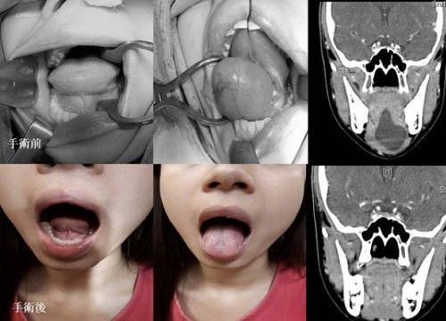 Cô gái nói chuyện không rõ, dưới lưỡi sưng phồng và có màu xanh giống như bụng nhái, bác sĩ kinh ngạc khi phát hiện khối u 6cm