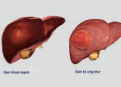 Ung thư "sát thủ" với nam giới bắt nguồn từ bệnh lý mãn tính