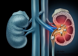 23 tháng đã bị sỏi thận, chuyên gia chỉ ra thủ phạm