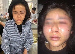 Cô gái bị hành hung suốt 2 giờ tại Yên Bái: Công an nói gì?