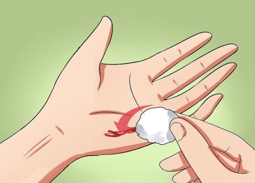 Hướng dẫn cách cầm máu khi bị thương