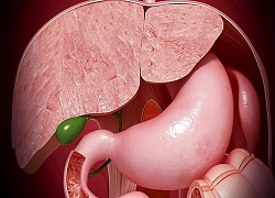 Polyp là gì? 4 bộ phận trong cơ thể nếu có polyp thì nguy cơ mắc bệnh ung thư là rất cao