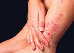 Bệnh eczema chữa khỏi được không?