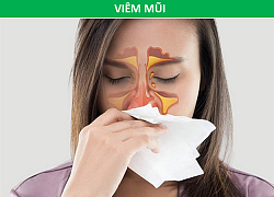 Cảnh giác với nhiều bệnh nguy hiểm khi mắt xuất hiện quầng thâm