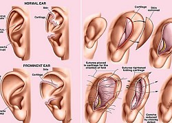 Nâng mũi từ sụn vành tai có lợi ích gì?